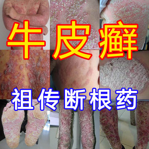 复方黄柏祛癣搽剂治疗牛皮癣银屑病止痒皮肤瘙痒去根除股体藓药膏
