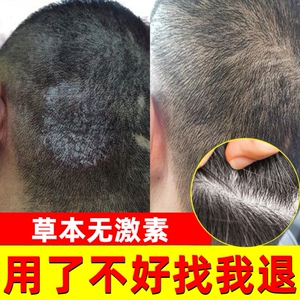 000人付款天猫头皮屑藓喷雾头皮真菌感染喷雾苗药廯痒净抑菌乳膏喷剂