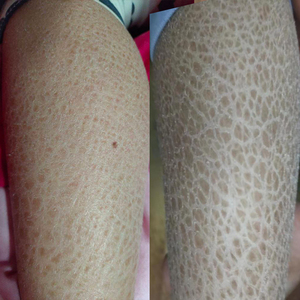 干性皮肤干燥起皮脱掉皮鱼鳞蛇皮毛周角化神器保湿干纹屑滋润补水