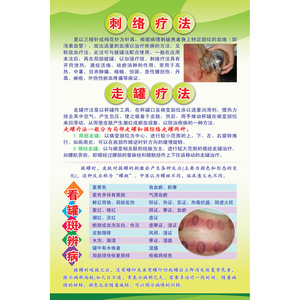 中医养生海报挂图 美容图片养生馆装饰画 宣传画刺络放血疗法走罐