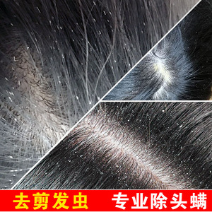 去卷发虫专业除吃发虫儿童去屑止痒断发抗真菌除螨虫剪发虫洗发水