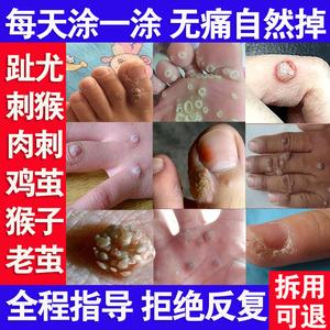 急眼膏肉刺足部