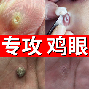 鸡眼清