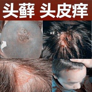 治头癣头皮癣药膏真菌感染头部红疙瘩头皮痒止痒膏毛囊炎去头皮屑