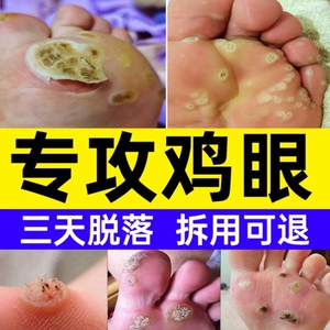 鸡眼药膏脚底