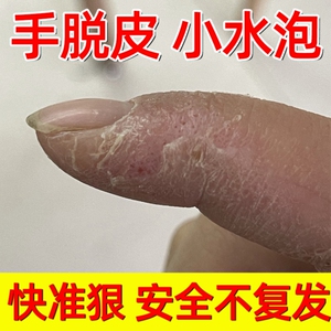 90131人付款淘宝真菌清霜细菌克星手气止痒杀菌软膏手上起小水泡皮肤