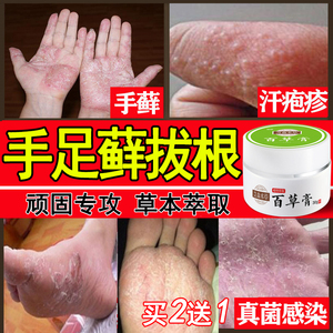 治手癣膏手足癣真菌感染手痒水泡脱皮干裂汗疱疹湿疹鹅掌风藓药膏