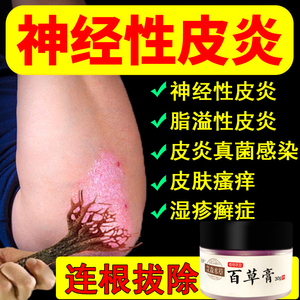 神经性皮炎膏无激素