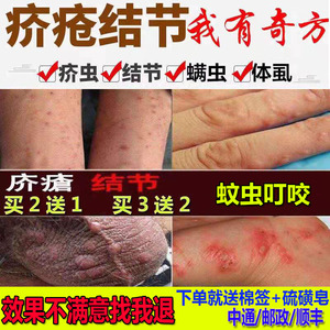 疥疮膏疥疮结节一扫光疥虫阴虱螨虫阴囊湿痒皮肤瘙痒止痒消肿药膏