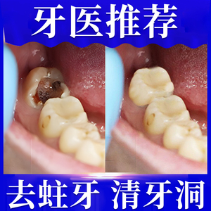 约肤儿童蛀牙牙洞清理神器龋齿去腐虫牙克星清理牙洞药防蛀牙牙虫