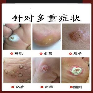 血胞刺去除膏跖疣特效药去鱼鳞痣根除足部脚底老茧神器日本鸡眼贴