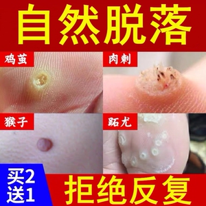 清尤灵去鸡贴眼鸡尤平趾疣去根鸡眼贴鸡眼膏瘊子去除神器鸡尤净