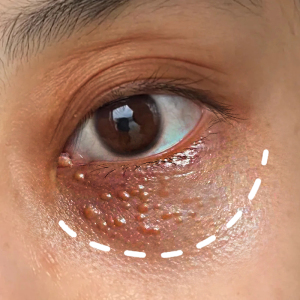 【李佳琪琦直播间】 视黄醇精华液眼霜 汗管瘤眼部脂肪粒去除神器