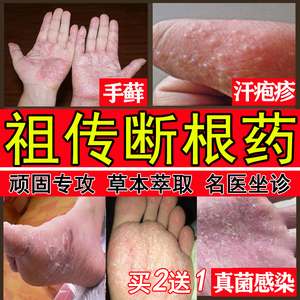 汗疱疹治疗水泡手脱皮的药干燥手部去手癣膏真菌感染止痒专用湿疹