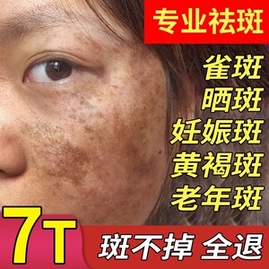 分解黑色素氢醌霜正品软膏乳霜祛黄褐斑雀斑色素沉着祛斑妊娠斑