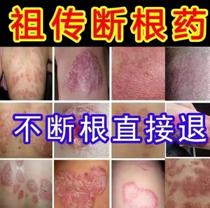 牛皮癣银屑癣外用断根头部湿疹颗粒灵特效黄柏祛搽剂专用治疗药膏