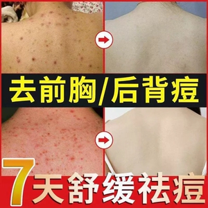背上痘痘祛痘去印后背