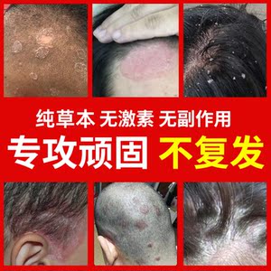 头皮藓药真菌牛皮癣药去屑止痒洗发水中药头上有疙瘩头皮藓擦去鲜