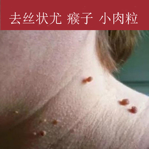 去肉痣