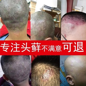 头皮屑头发毛囊炎专用药私处去男士克星治疗头皮癣药膏真菌感染