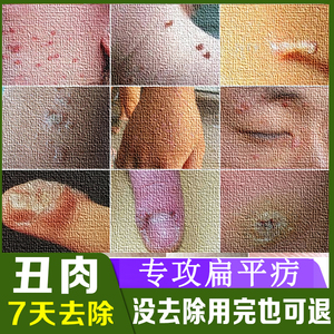 去除扁平疣药膏脸部