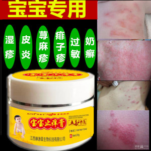 治疗宝宝婴儿儿童寻荨麻疹外用药过敏性皮炎湿疹止痒断根专用药膏