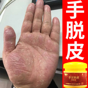 80螺丝钉炒肉淘宝鹅掌风特效的药专治疗手癣药膏手痒干裂真菌感染
