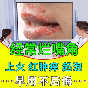 90时间都去哪儿了1221淘宝唇愈堂嘴唇疮口上火起泡嘴角起水泡黏水疮