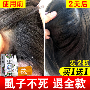 虱子药儿童头虱子小女孩头发虱卵一扫光百部酊阴虱药男士用猫狗狗