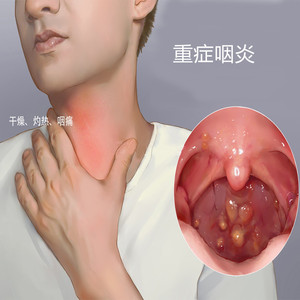 日本咽喉扁桃体发炎肥大肿大喉咙肿痛有痰异物嗓子咳嗽咽喉干痒