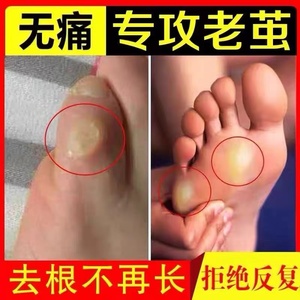 去老茧脚茧子去除神器小脚趾去老茧治脚垫的药脚底胼胝死皮软化剂