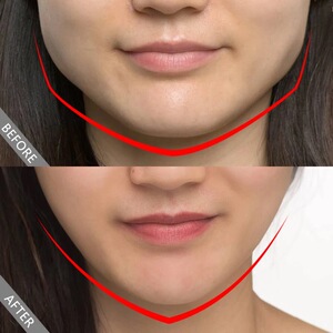 瘦脸神器瘦咬肌v脸双下巴颧骨缩小神器消颧骨瘦骨脸骨瘦脸精油女