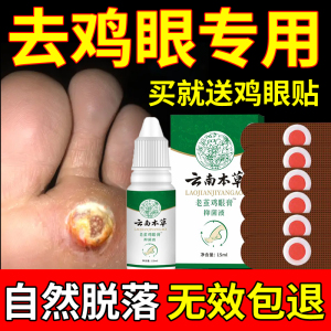 鸡茧膏鸡眼贴脚瘊子去除液足部手部根肉刺贴非脚鸡茧药鸡尤平