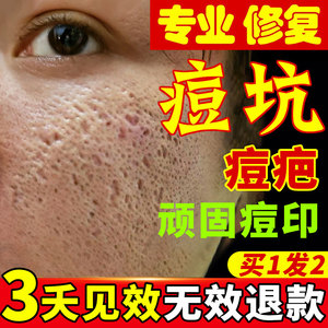 90资莱皙旗舰店天猫芦荟胶祛痘修复痘坑淡化痘印凝胶官方旗舰去痘坑