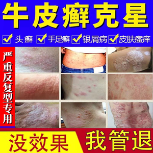 治牛皮癣藓银屑病皮肤真菌感染祛手足体股癣湿疹止痒去根特效药膏