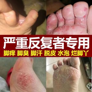 复方硫磺软膏皮肤外用煤焦油软膏流黄软膏皮炎宁酊正品抑菌止痒