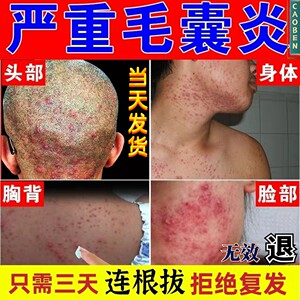 治疗头皮毛囊炎专用头部脖子前胸后背私处马拉色菌痘痘中药酊膏药