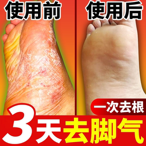 治疗脚气膏止痒真菌感染去根神器药根治水泡型脚癣药膏藓脱皮杀菌