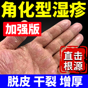 角化型湿疹止痒去成人手癣膏脱皮干裂真菌感染外用顽固皮炎根cc