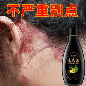 毛囊炎毛焱清洗发水露除螨虫去头皮屑控油止痒清洁头皮去屑洗发水