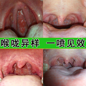 蜂胶咽喉炎慢性咽炎异物感特效咽炎茶除根神器茶治疗有痰化痰滤泡