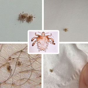 阴虱男女私处去虱子神器下面阴毛瘙痒长虫子体虱卵一扫光喷剂