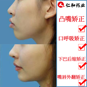 改善嘴凸突厚嘴唇变薄上嘴唇外翻颚口呼吸凸嘴下巴后缩矫正器神器