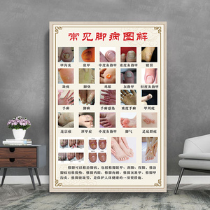 甲沟炎海报足疗店养生馆宣传墙贴灰指甲挂图修脚图解挂画装饰画