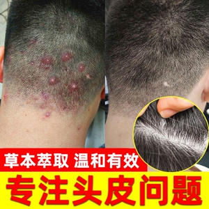 治头皮屑的药擦头皮湿疹止痒去根去痒药膏苗家药膏止痒头皮痒药膏