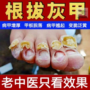 齐峰草本液蜂堂灰甲清丁去氏灰甲厚净指甲软甲速速记济剂神笔液