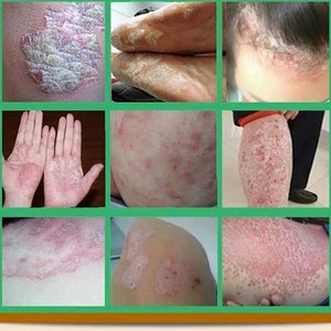 藓草膏外用癣根除草本止痕膏私处皮肤大腿内侧痒止痒男女士