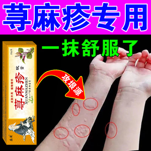 治儿童去胆碱能慢性荨麻疹过敏止瘙痒根专用中药膏风团划痕皮肤