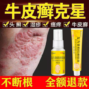 0086人付款淘宝苗方清毒治牛皮铜钱藓癣大腿内侧股藓膏肛门私处皮肤