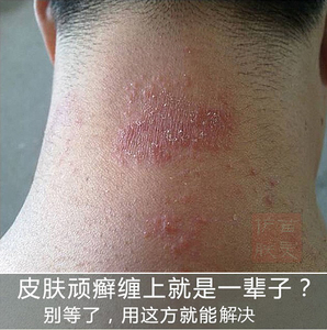 皮肤瘙痒止痒抑菌全身痒外用药治老人大小腿脖子起皮干痒私处阴囊